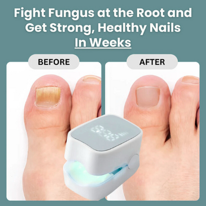 Maylo Pro™ - Nail Fungus Laser Device