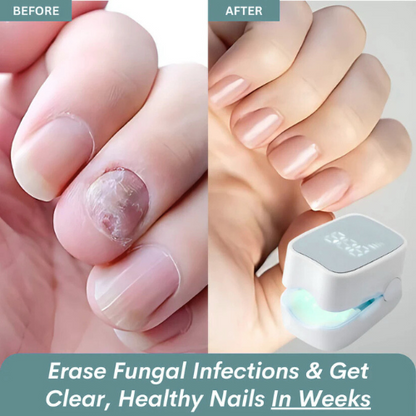 Maylo Pro™ - Nail Fungus Laser Device