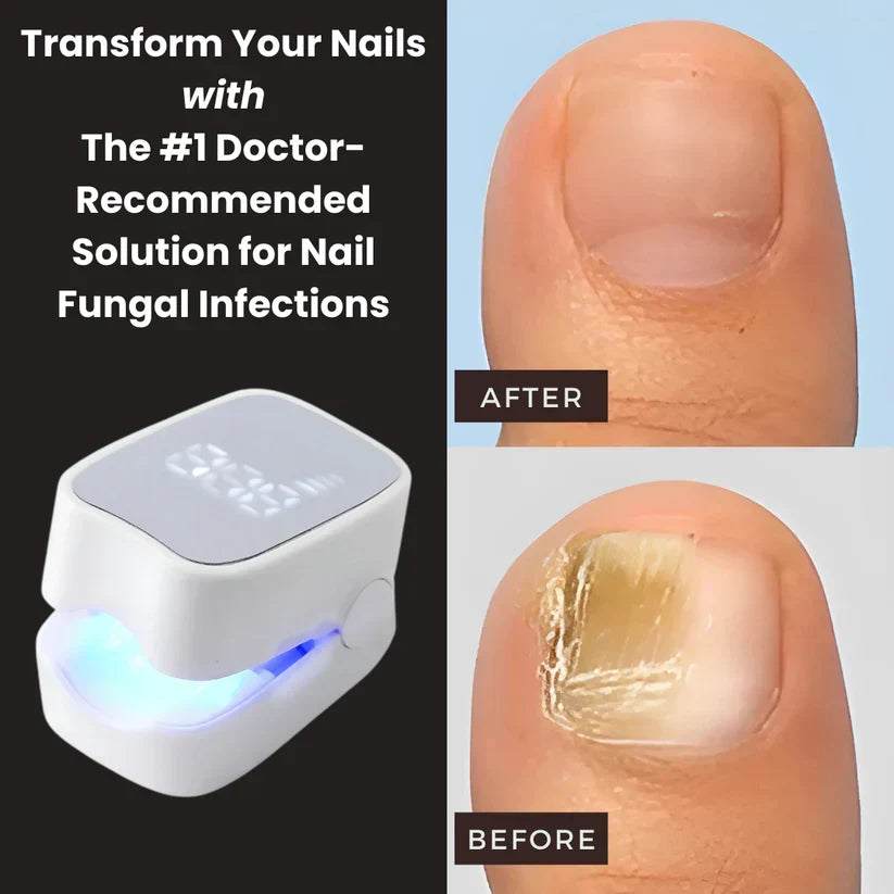 Maylo Pro™ - Nail Fungus Laser Device